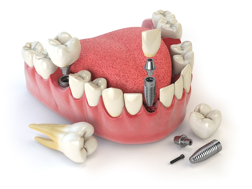 implantes dentales en silao