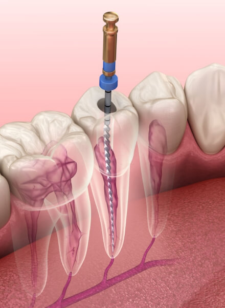 Endodoncia-1