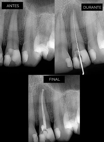 endodoncia-3